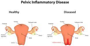 Can Pelvic Inflammatory Disease Cause Infertility?