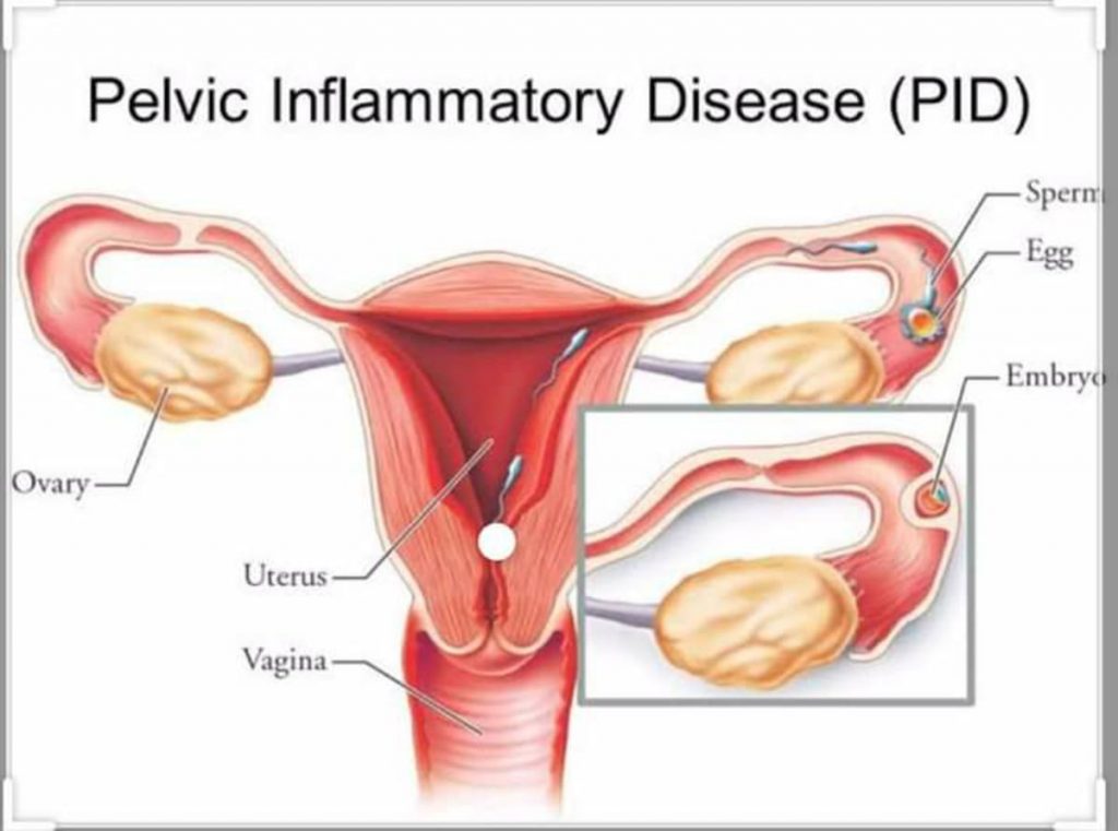 Getting Pregnant With Pelvic Inflammatory Disease