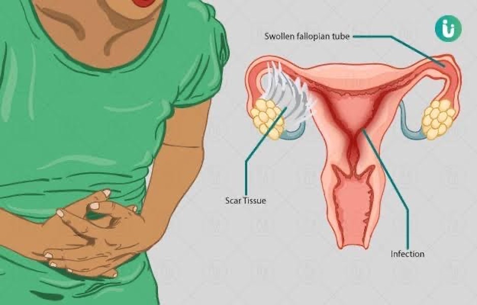 Link Between Pelvic Inflammatory Diseases And Infertility