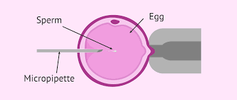 Facts About Intracytoplasmic Sperm Injection