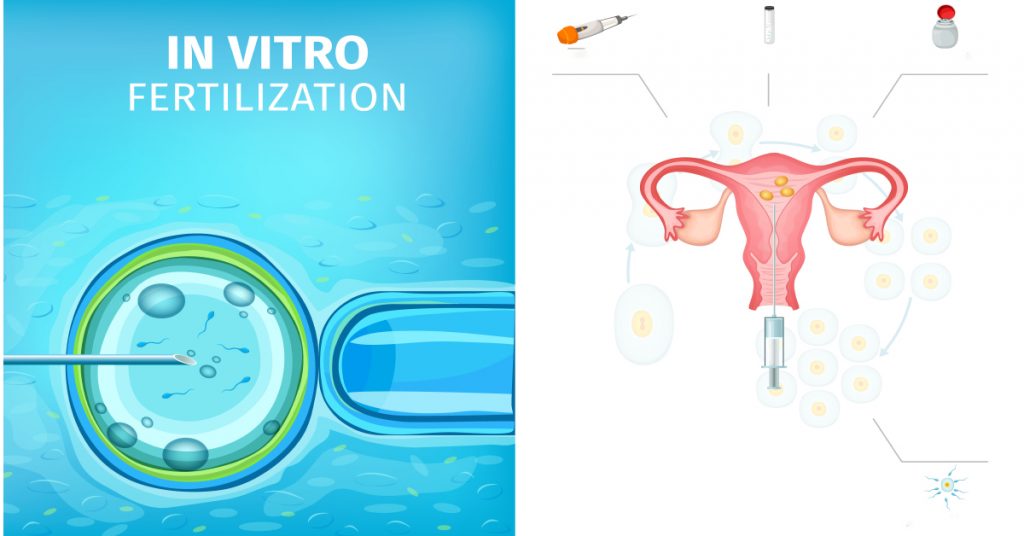 Fertility: How Treatment Through Intrauterine Insemination Procedure Works