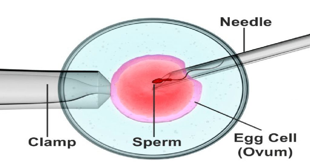 Intracytoplasmic Sperm Injection And Fertilisation Of Women’s Egg