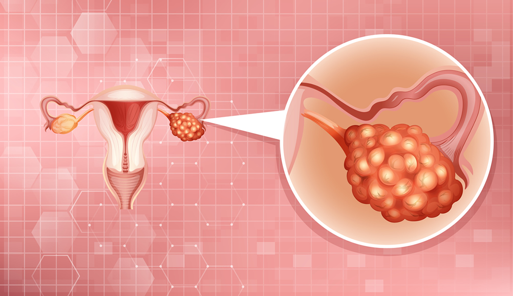 Ovarian Reserve: Egg Quantity, Quality And Fertility