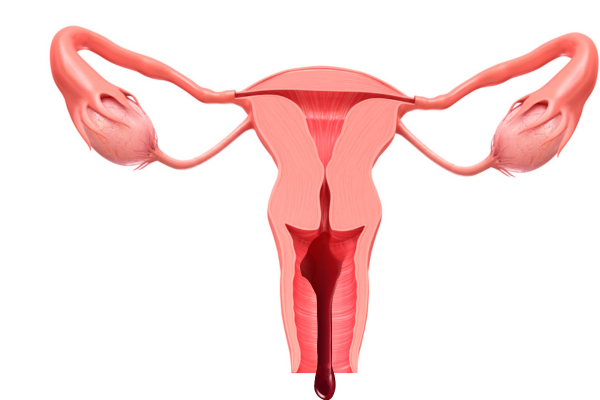 Can Abnormal Uterine Bleeding Lead To Infertility