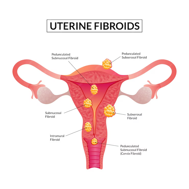 Uterine Fibroids and Infertilty (continuation)